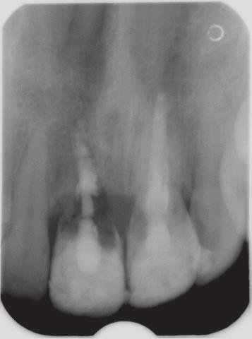 Ząb 11 korzeń został całkowicie zresorbowany. Ząb 21 widoczne objawy ankylozy na dystalnej powierzchni korzenia. and the access cavities were obturated with glassionomer material Ketac Molar (Fig. 9).