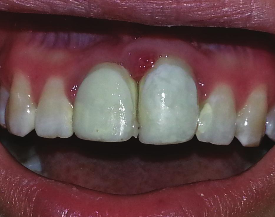 J Stoma 2015; 68, 1 Ciesielski P., Sulwińska M., Łaszkiewicz J. Fig. 12. Photograph taken before decoronation of tooth 11. Zdjęcie wykonane przed zabiegiem dekoronacji zęba 11. Fig. 13. Removed crown.