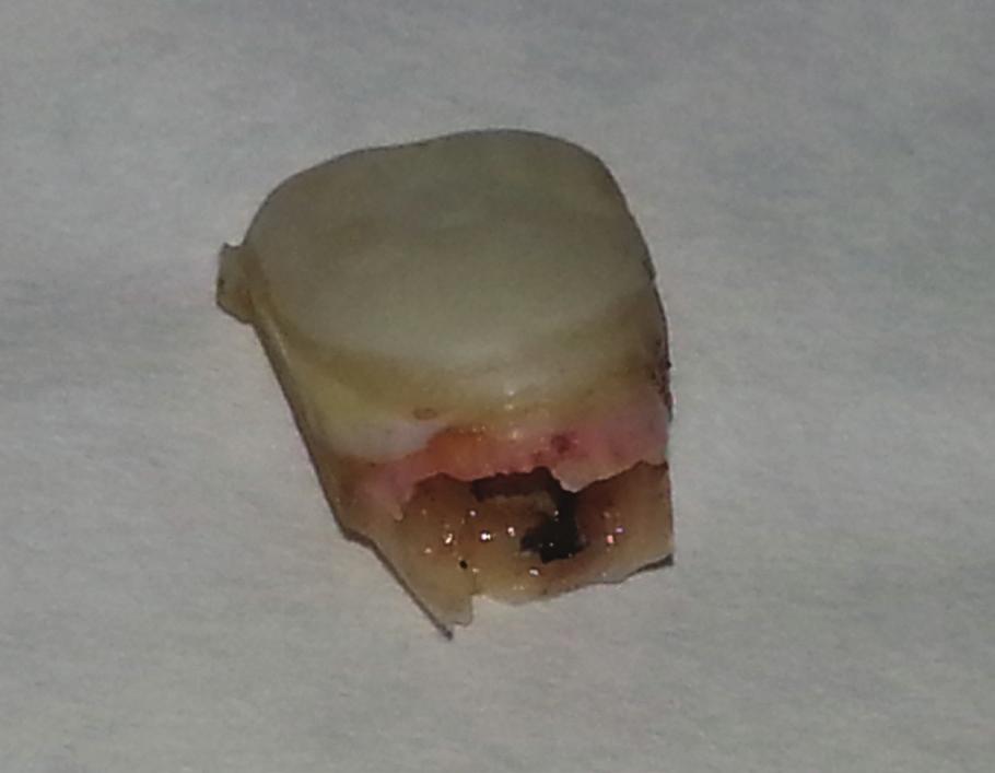 An X-ray photograph confirmed homogenous obturation of the root canals in teeth 11 and 21. Access cavities in the incisors were restored with Herculite composite material on the following appointment.