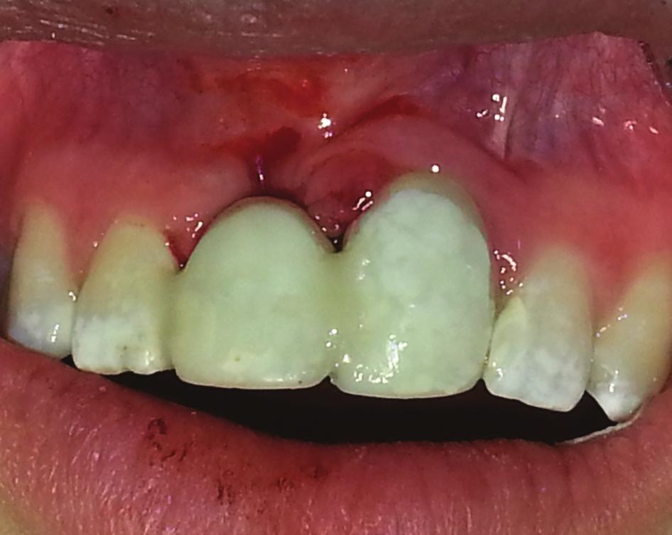 It was then observed that the periodontal space in tooth 11 had become less visible and root tissues had been replaced with bone tissues.
