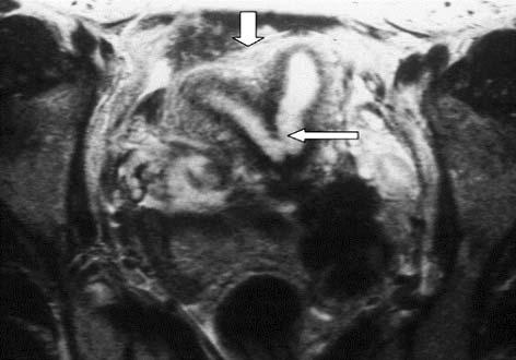 Zastosowanie histeroskopii w diagnostyce i leczeniu przegrody macicy doświadczenia własne i przegląd piśmiennictwa W diagnostyce wad macicy stosuje się także tomografię rezonansu magnetycznego (MRI)