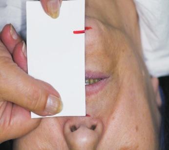 Płaszczyzna zwarcia przy obecności w jamie ustnej poprzednio wykonanych protez: a w odcinku bocznym po stronie prawej, b w odcinku