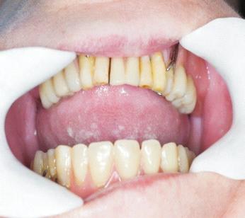 żuchwie: 43, 42, 32, 33, 34. Kolejną czynnością było skrócenie zębów bocznych w dotychczas użytkowanej przez pacjentkę protezie częściowej osiadającej górnej.