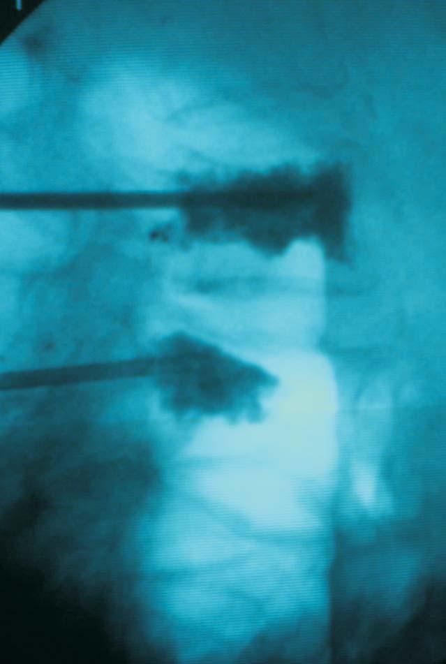 primary or metastatic neoplastic disorders. Vertebroplasty is an example of small-invasive surgery procedures giving fast clinical effect.