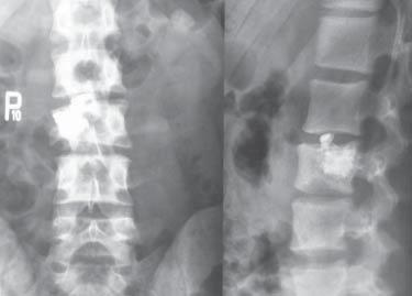 Complications of cement percutaneous vertebroplasty patients (19.5). In the majority of cases the leakage was asymptomatic and was collected outside the spinal canal [18].