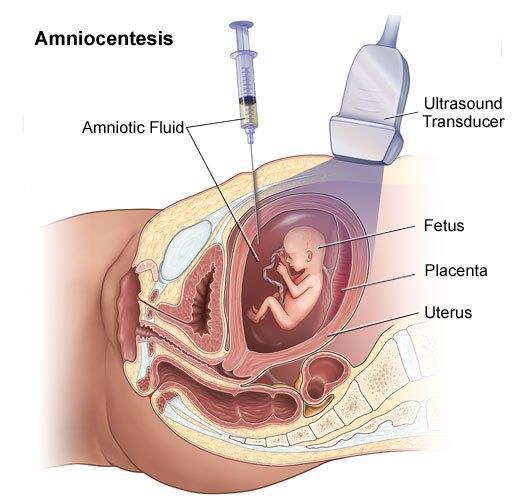 DIAGNOSTYKA PRENATALNA nieinwazyjna