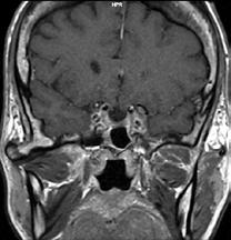 Epidemiology and long-term survival in acromegaly.