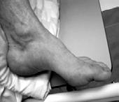 wzrokowych. Główna masa guza wpukla się do zatoki klinowej. Stężenie pozostałych hormonów tropowych przysadki było prawidłowe. Schorzenia towarzyszące akromegalii w momencie rozpoznania obejmowały: 1.