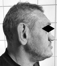 Twarz pacjenta en face w stronę lewą względem płaszczyzny strzałkowej pośrodkowej (ryc. 2).
