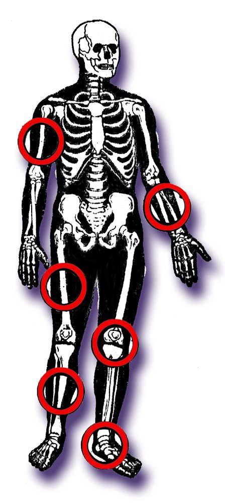Szczególnie tam, gdzie istnieją trudne warunki techniczne do zespalania wewnętrznego, np. Osteotomii podkolanowej, usztywnieniu stawu skokowego itp.