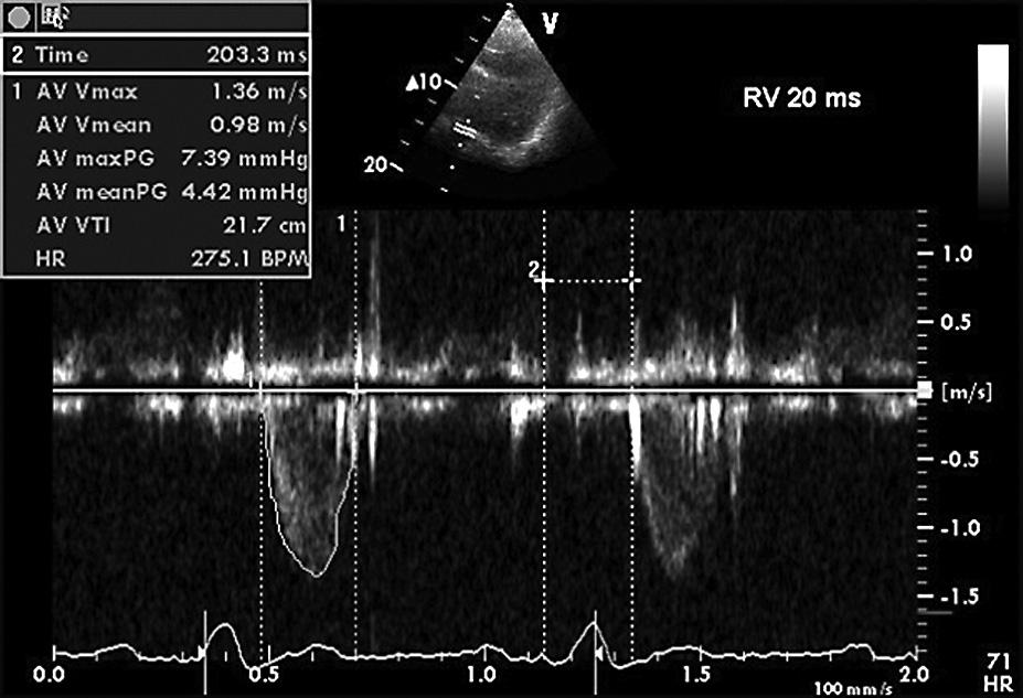 Folia Cardiologica Excerpta 2007, tom 2, nr 7 A B C D E Rycina 3. Przypadek nr 1.