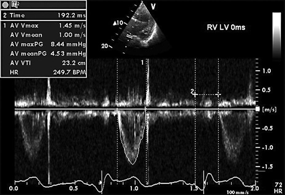 VTI LVOT oznaczono jako AV VTI, wartość LPEI podano jako pierwszą w tabeli i oznaczono jako 2 Time. A. Preekscytacja prawej komory o 20 ms: VTI LVOT = 21,7 cm, LPEI = 203 ms. B.