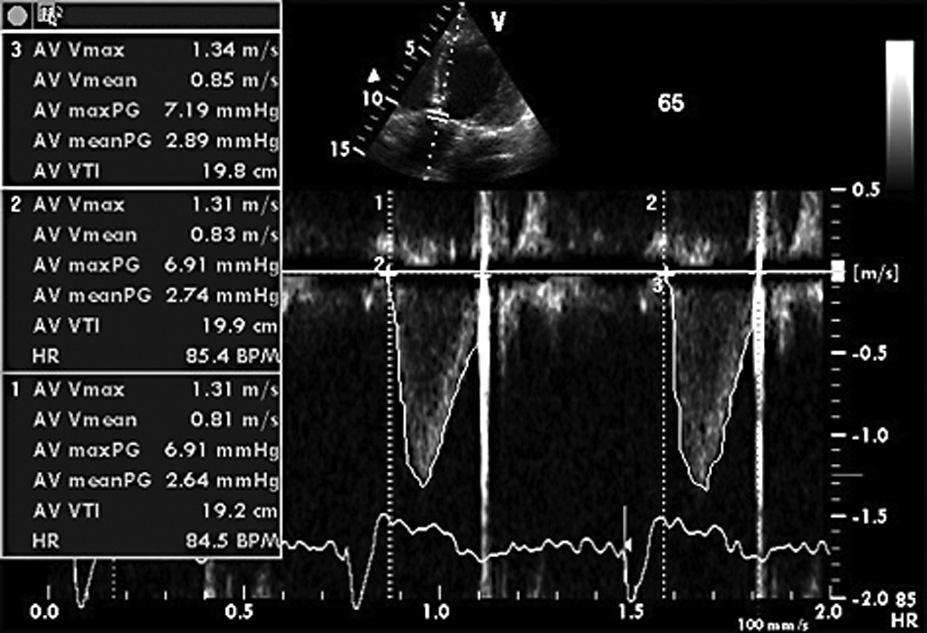 Folia Cardiologica Excerpta 2007, tom 2, nr 7 z 5 pomiarów VTI LVOT. Uzyskane wartości usystematyzowano i przedstawiono w tabeli 2.