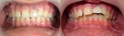 Post-traumatic ankylosis of tooth 21. Image taken seven years after a tooth trauma.