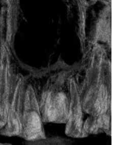 Lack of the periodontal fissure and partial replacement of root tissues by bone tissue visible in an X-ray image. w łuku przeciwstawnym.