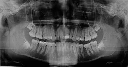 Zalecane jest wykonanie osteodystrakcji z nadkorektą 1,0 mm uwzględniającą kontynuację wyrzynania sąsiednich zębów i potencjalny nawrót (10). Inną procedurę przedstawił Issacson i wsp.