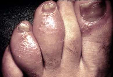 Palec kiełbaskowaty (dactylitis) Uogólniony obrzęk palca na skutek zapalenia błony maziowej, pochewek ścięgnistych, przyczepów ścięgnistych