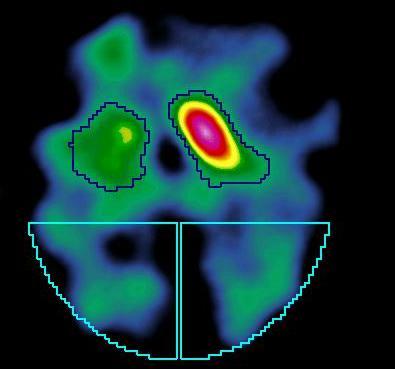 chorobie Alzheimera Objawem charakterystycznym jest