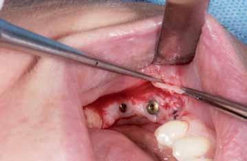 Wprowadzono implanty Dentsply Astra EV w pozycjach 35, 36 i 37.