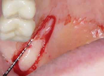 _CBCT Ryc. 19 Ryc. 20 Ryc. 19_Pobranie przeszczepu z granicy okolicy podniebiennej i guza szczęki. Ryc. 20_Zaopatrzenie rany opatrunkiem BloodStop. Ryc. 21_Stabilne umocowanie przeszczepu tkanki miękkiej pełnej grubości (z warstwą nabłonka zrogowaciałego).