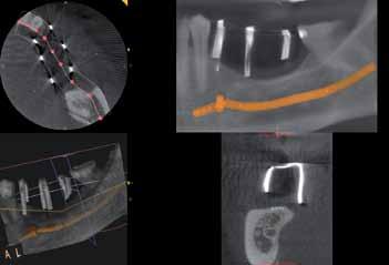 _CBCT Ryc. 25 Ryc. 26 Ryc. 25_Założenie łączników Atlantis. Ryc. 26_Zacementowanie koron. Ryc. 27_Poprawa objętości tkanek miękkich i szerokości dziąsła związanego.
