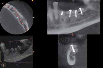 _CBCT Ryc. 3rtg Ryc. 4rtg Ryc. 5rtg Ryc. 6rtg Ryc. 3rtg i 4rtg_Stan po zespoleniu przeszczepu kości autogennej. Ryc. 5rtg i 6rtg_Stan po implantacji. cech martwicy kości.