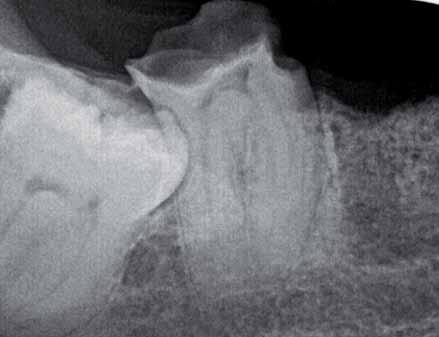 _CBCT Ocena efektywności wypełnienia kanałów w leczeniu endodontycznym z zastosowaniem tomografii wiązki stożkowej Evaluation of the effectivenes of root canal obturation using cone beam CT Autorzy_