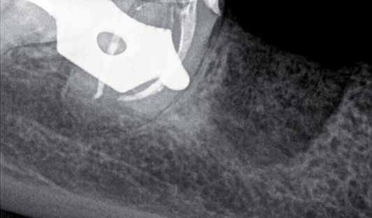 _CBCT Ryc. 2 Ryc. 3 flaring, przy użyciu instrumentu K3 (SybronEndo, Orange, USA) w rozmiarze 25/12 oraz 25/10.