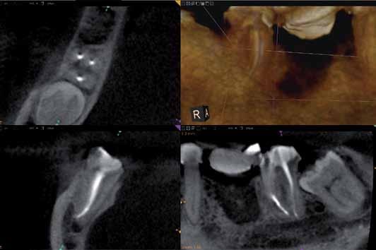 _CBCT Ryc. 4 _autorzy Lek. dent. Bartłomiej Karaś Prywatna Praktyka Dentystyczna we Wrocławiu, Dział Badawczy Polskiego Towarzystwa Endodontycznego, kierownik: dr n. med. Wojciech Wilkoński. Lek. dent. Przemysław Papiór Prywatna Praktyka Dentystyczna we Wrocławiu.