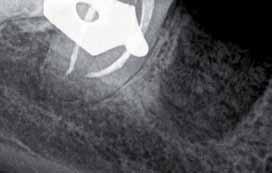 kanałów w leczeniu endodontycznym z zastosowaniem tomografii wiązki