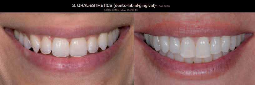 _smile analysis and smile design Fig. 4_Evaluating the maxillary incisal edge position is the starting point for establishing oral aesthetics. Fig. 5_According to the 4.2.