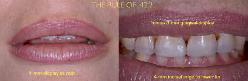 lower lip (right). Fig. 4 Fig. 5 Fig. 6_Gingival symmetry in relation to the central incisors, lateral incisors and canines is essential to aesthetics.