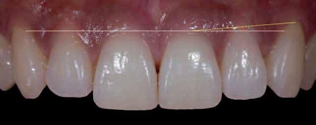 7_The aesthetic ideal from the gingival scallop to the tip of the papilla is 4 5mm. Fig. 6 Fig.