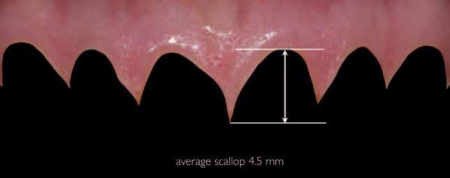 As gingival heights are measured, heights relative to the central incisor, lateral incisor, and canine in an up/down/up relationship are considered aesthetic (Fig. 6).