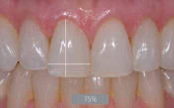 _smile analysis and smile design Fig. 8 Fig. 9 Fig.