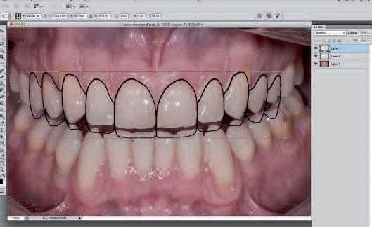 _smile analysis and smile design Fig. 27 Fig. 28 Fig. 29 Fig. 30 Fig. 27_Open the image of the chosen tooth grid in Photoshop and drag the grid on to the image of teeth to be smile designed.