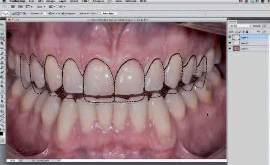_smile analysis and smile design Fig. 31 Fig. 32 Fig. 33 Fig. 34 _Click and drag the ruler tool from the top to the bottom of the tooth to generate a vertical number, in this case 170 pixels (Fig.