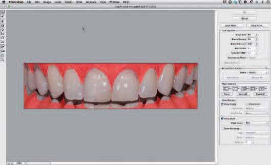 Select a tooth grid based on the width-to-length ratio of the planned teeth (e.g., 80/70/90 or 80/65/80).