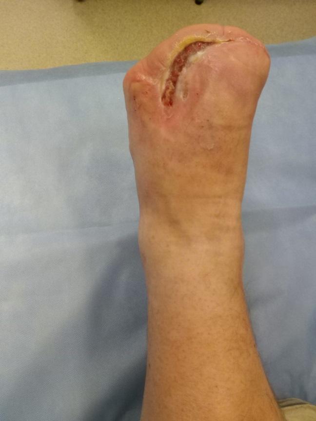 Dig. 1. The patient with a diabetic foot syndrome, amputation of fingers.