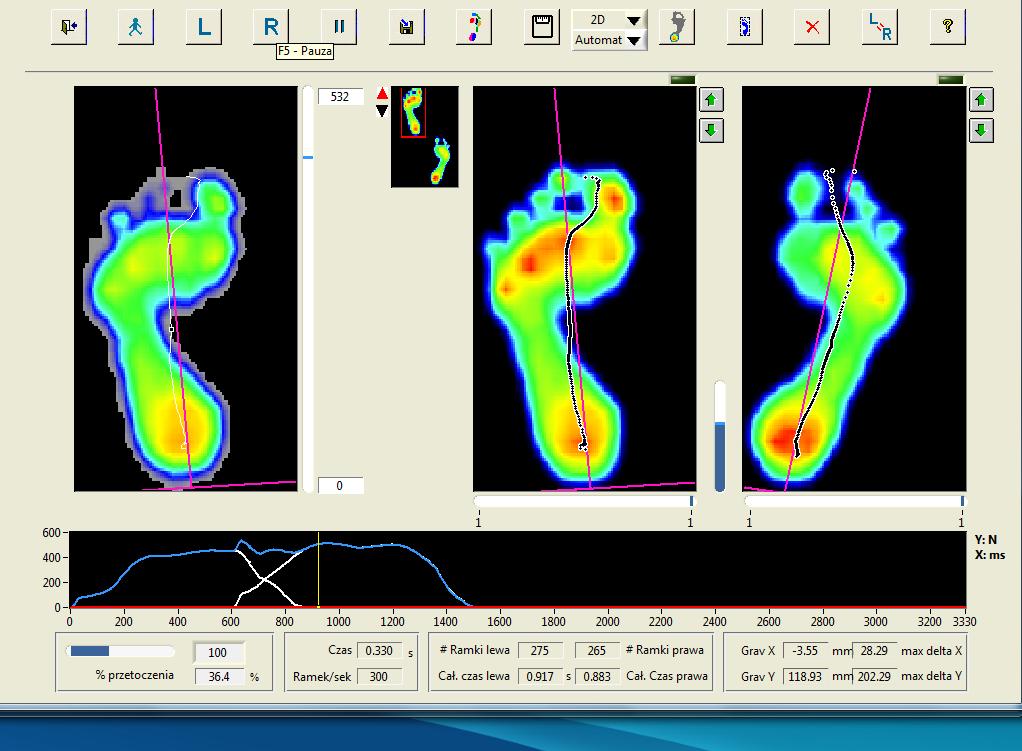 Dig. 3. Study on plantar pressure distribution of the foot using pedobarograph.