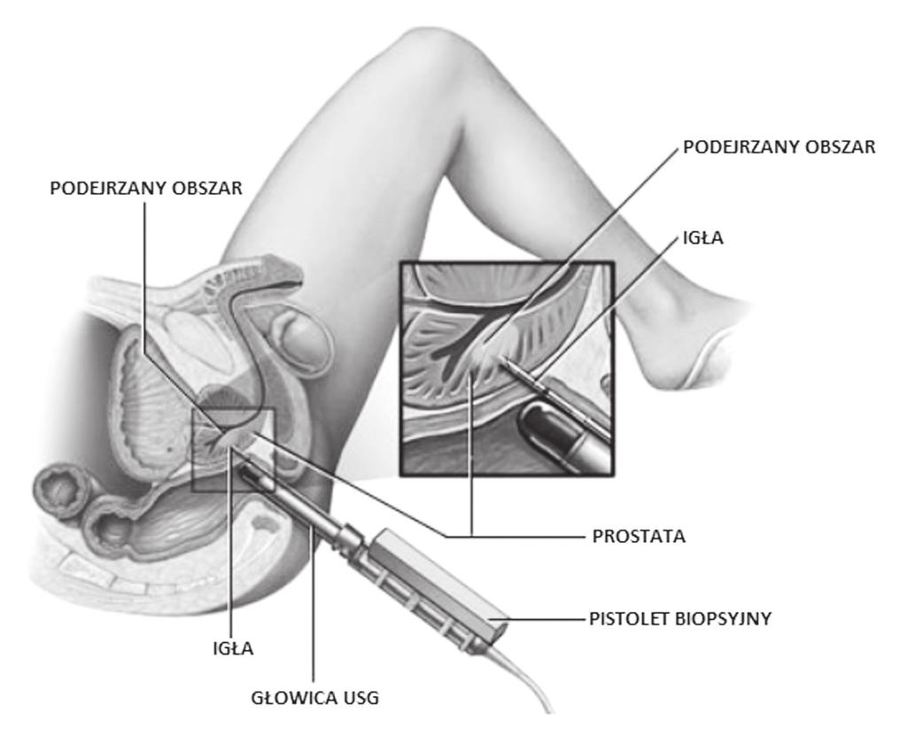 dyskomfortem. Po wprowadzeniu głowicy dokonuje się oceny anatomii i wielkości prostaty. Następnie pod kontrolą usg zwykle podawane jest znieczulenie miejscowe.