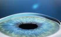 Minimalnie inwazyjny zabieg bez płatka Korekcja wad refrakcji techniką ReLEx SMILE Technika LASIK polega na wytworzeniu płatka rogówki, który odwija się, aby umożliwić stopniowe usunięcie tkanki