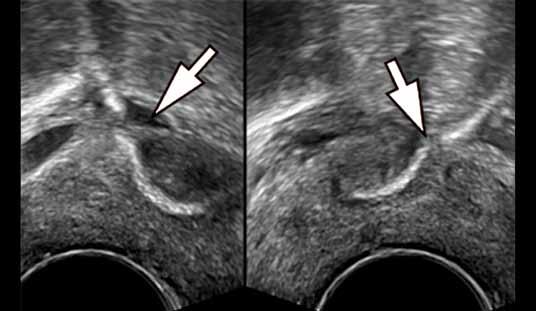 Rola badania ultrasonograficznego w diagnostyce powikłań po operacjach z powodu WNM 455 Rycina 10.