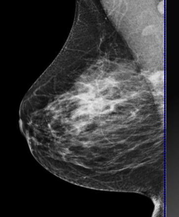 mammografia MMG obraz niejednoznaczny, wątpliwy, zmiana podejrzana zdjęcie celowane ( jeśli to możliwe