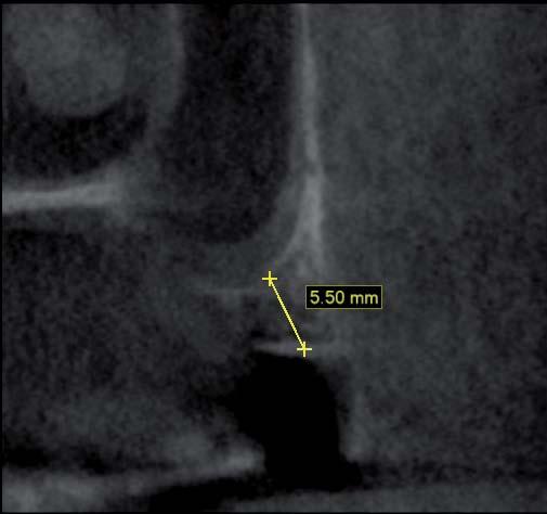 Grzegorz Ziętek, Ryszard Koczorowski Rycina 5. Część zdjęcia ortopantomograficznego oraz rzutu CBCT z określoną grubością kości przed zabiegiem Figure 5.