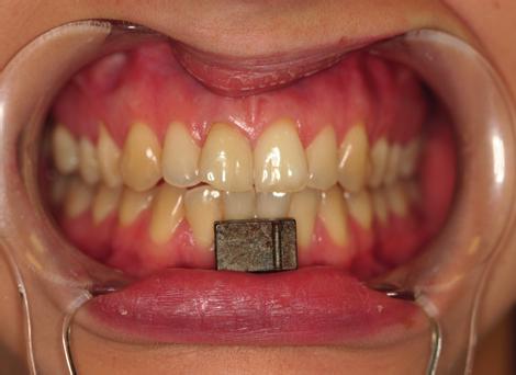 ) założony na głowę pacjenta, rejestrujący zmianę położenia bloczka magnetycznego umieszczonego w punkcie siecznym w żuchwie. Fig. 2. A magnet placed in the mandibular incisal point.