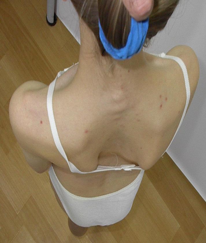 Warunki do rozpoznania skoliozy idiopatycznej ( Scoliosis Research Society ) Deformacja kręgosłupa w trzech płaszczyznach przestrzeni: płaszczyzna czołowa- boczne