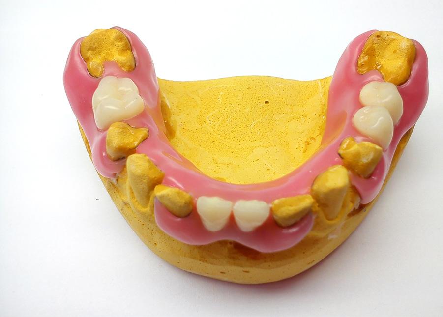 Fot. 8. Modelowanie w wosku. Płytkę wosku rozgrzewam nad palnikiem i dociskam do modelu. Ostrym nożykiem obcinam nadmiary i przyklejam płytę protezy do modelu zgodnie z zarysowanym zasięgiem.