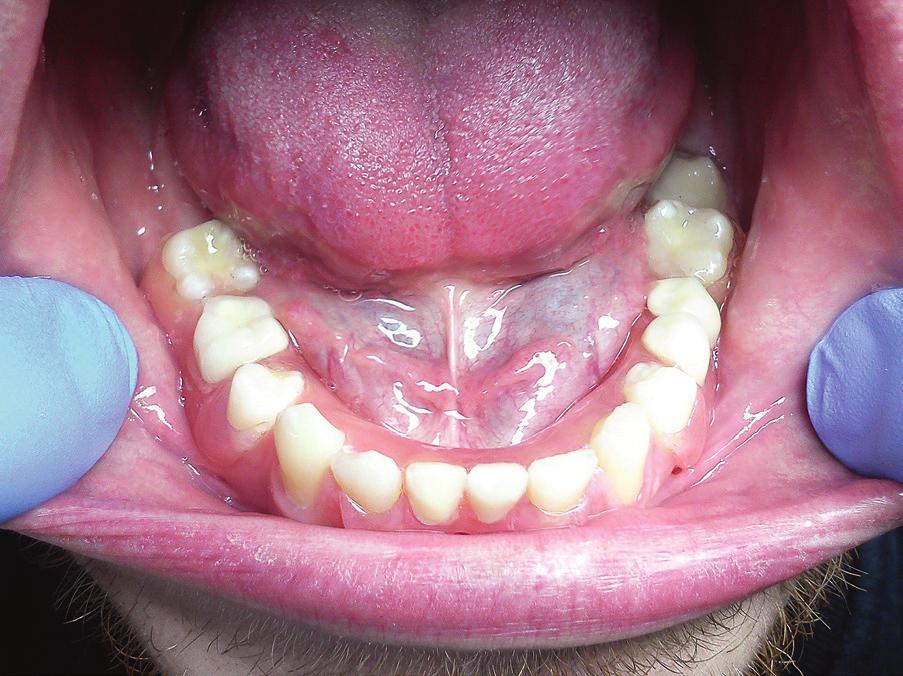 Fot. 15a-b. Proteza w ustach pacjenta. W tak trudnych sytuacjach protetycznych jak opisane powyżej ACRON jest jedynym materiałem, który zapewnia powodzenie pracy.