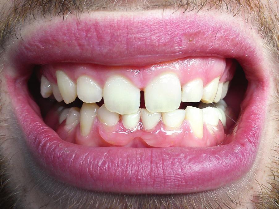 przypadkach mocno wychylonych zębów, pozbawionych powierzchni prowadzącej.